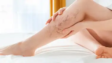 3 tratamientos naturales para eliminar las várices fácil y rápido 3 tratamientos naturales para eliminar las várices fácil y rápido