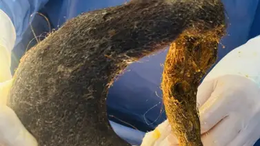 Ecuador | Médicos extraen enorme bola de pelo del estómago de una joven Ecuador | Médicos extraen enorme bola de pelo del estómago de una joven