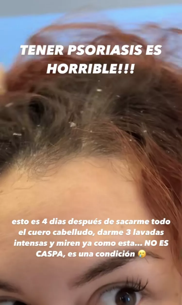 La enfermedad dermatológica que sufre la hija de Daddy Yankee La enfermedad dermatológica que sufre la hija de Daddy Yankee
