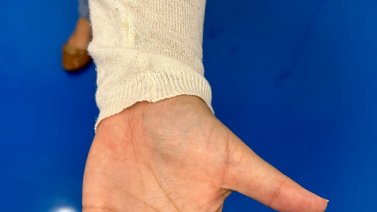 Implantan el primer marcapasos sin cable en Venezuela