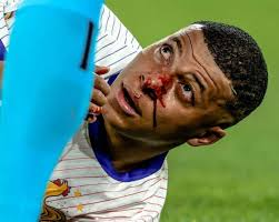 Así quedó la nariz de Mbappé tras el partido de Francia vs Austria (+Fotos)