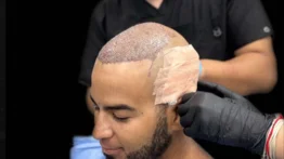 Abrió al público Spiro Hair Restoration Center para el implante capilar aplicando el sistema ARTAS IX
