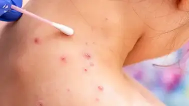 Reaparece viruela del mono en este condado de EEUU (+Recomendaciones) Reaparece viruela del mono en este condado de EEUU (+Recomendaciones)