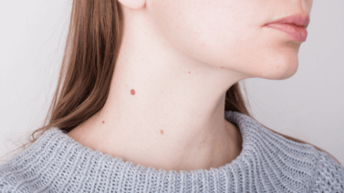 Cómo quitar las verrugas del cuerpo rápido y sin cirugía