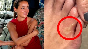 Influencer revela que tiene un gusano vivo dentro de su pie