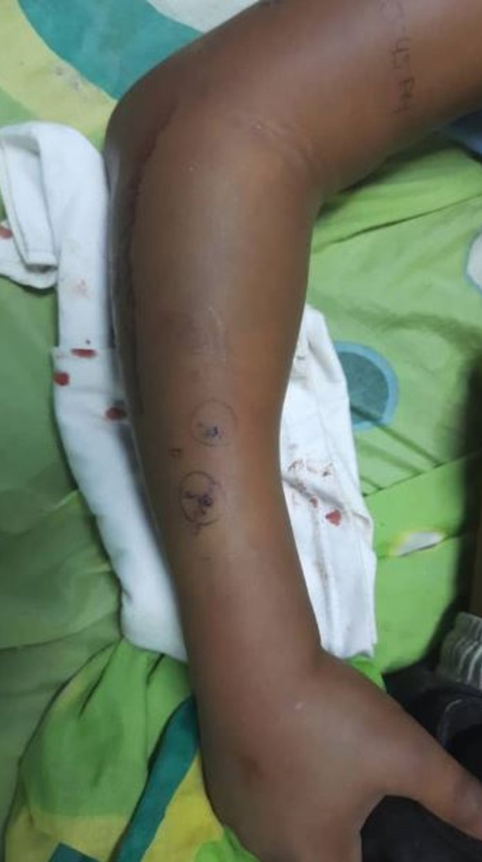 Serpiente mordió dos veces a un niño: tuvieron que amputarle el brazo Serpiente mordió dos veces a un niño: tuvieron que amputarle el brazo