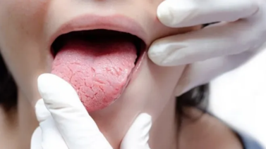 Conoce el por qué y su tratamiento de la lengua fisurada