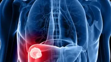 ¡Alerta! Brote de hepatitis E deja al menos doce muertos ¡Alerta! Brote de hepatitis E deja al menos doce muertos