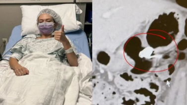 Mujer se traga un AirPod y sigue funcionando en su estómago