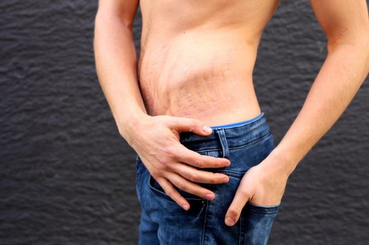 Los hombres también sufren de estrías ¡Elimínalas! Los hombres también sufren de estrías ¡Elimínalas!