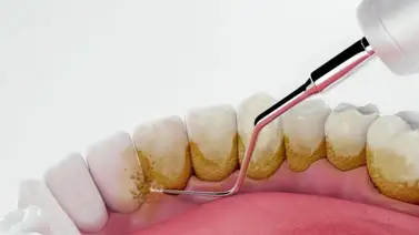 Así puedes combatir los tipos de placa bacteriana Así puedes combatir los tipos de placa bacteriana