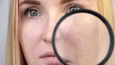 Poros dilatados ¿Cómo mejorar su apariencia? Poros dilatados ¿Cómo mejorar su apariencia?