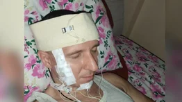 En imágenes | Un hombre perforó su cráneo por este motivo