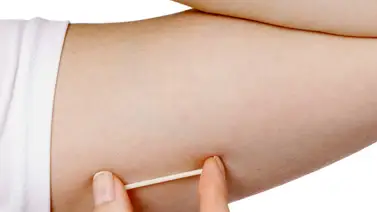 Implante anticonceptivo Ventajas y desventajas Implante anticonceptivo Ventajas y desventajas