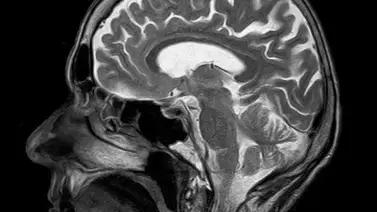 ¿Por qué?: Esta región cerebral es clave en el alzheimer ¿Por qué?: Esta región cerebral es clave en el alzheimer