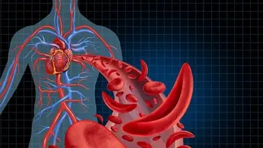 Un mal poco conocido ¿Sabe usted qué es la drepanocitis? Un mal poco conocido ¿Sabe usted qué es la drepanocitis?