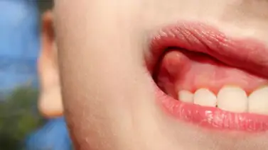 Tratamientos para eliminar un flemón bucal Tratamientos para eliminar un flemón bucal