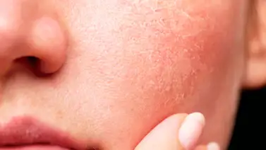 Descubre cómo sufre la piel si no tomas agua Descubre cómo sufre la piel si no tomas agua