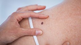 Causas principales del cáncer en la piel