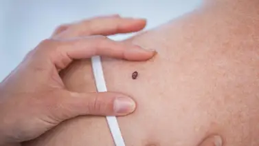 Causas principales del cáncer en la piel Causas principales del cáncer en la piel