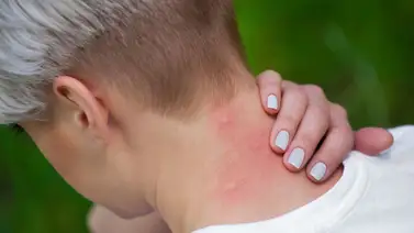 ¿Alergia a mosquitos? Puedes sufrir del síndrome skeeter ¿Alergia a mosquitos? Puedes sufrir del síndrome skeeter
