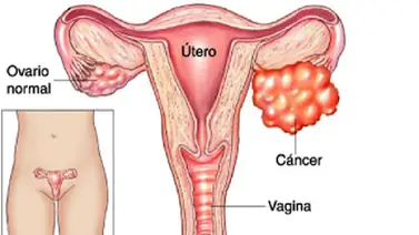 ALERTA: Conoce un enemigo silencioso y mortal para las mujeres ALERTA: Conoce un enemigo silencioso y mortal para las mujeres