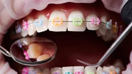 ¡PELIGRO EN LA CALLE!: Alertan sobre los gravísimos riesgos de los "brakes" dentales piratas