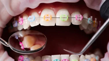 ¡PELIGRO EN LA CALLE!: Alertan sobre los gravísimos riesgos de los "brakes" dentales piratas