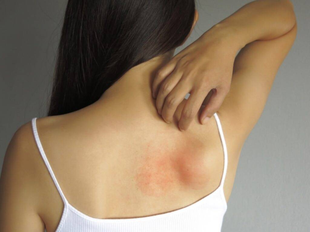 Alergia emocional ¿sabes cómo tratarla?