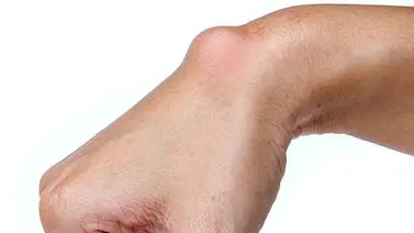 Cómo tratar un lipoma o quistes de grasa Cómo tratar un lipoma o quistes de grasa