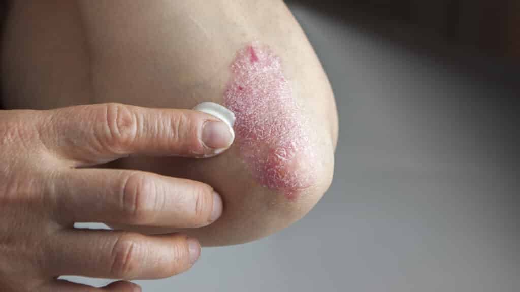 ¿Problemas en la piel? Podrías padecer de psoriasis