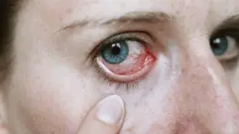 Te explicamos todo sobre tener ojos enrojecidos