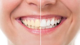 Blanquea tus dientes sin necesidad de ir al dentista