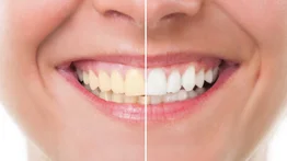 Blanquea tus dientes sin necesidad de ir al dentista