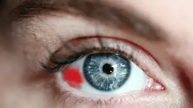 Derrame ocular: causas y consecuencias Derrame ocular: causas y consecuencias