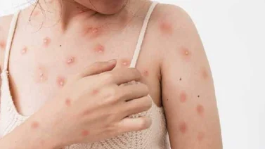 Panamá detecta el primero caso de viruela del mono en una mujer