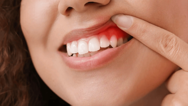 Tres formas de tratar el absceso dental