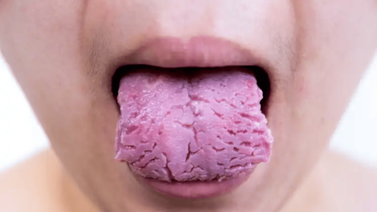 ¿Por qué se nos agrieta la lengua?