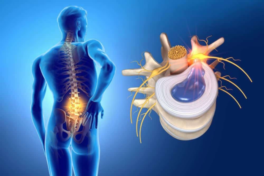 Conoce los síntomas de la hernia discal lumbar Conoce los síntomas de la hernia discal lumbar