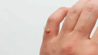 ¿Qué son los cadillos y cómo tratarlos? ¿Qué son los cadillos y cómo tratarlos?