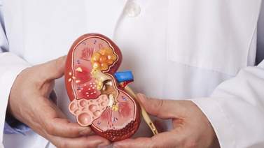 ¿Cómo se forman los cálculos renales?