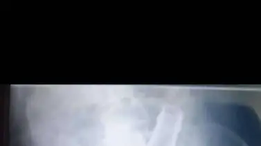 Septuagenario ingresó a centro asistencial con una botella alojada en el recto Septuagenario ingresó a centro asistencial con una botella alojada en el recto