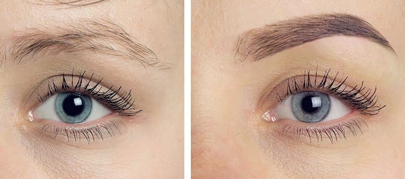 Implantes de cejas: algo más que estético Implantes de cejas: algo más que estético