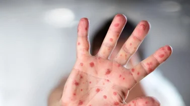 Perú acumula 1.844 casos de viruela del mono