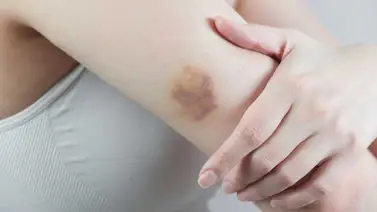 Remedios caseros para tratar los golpes y moretones Remedios caseros para tratar los golpes y moretones