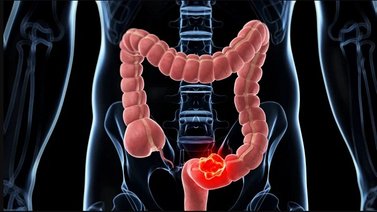 Atento con tu salud: Estos son los síntomas del cáncer de colon