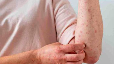 La viruela del mono ha superado los 50 mil contagios en el mundo
