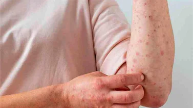 La viruela del mono ha superado los 50 mil contagios en el mundo