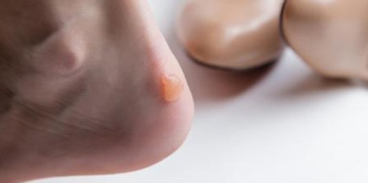 ¿Por qué salen las ampollas de los pies y cómo curarlas? ¿Por qué salen las ampollas de los pies y cómo curarlas?