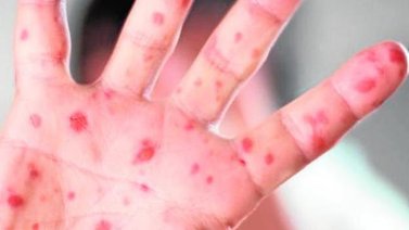 Detectan un nuevo virus llamado "la gripe del tomate" en la India